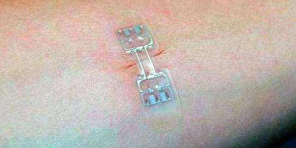 Пластир microMend: забудьте про швах і скобах!